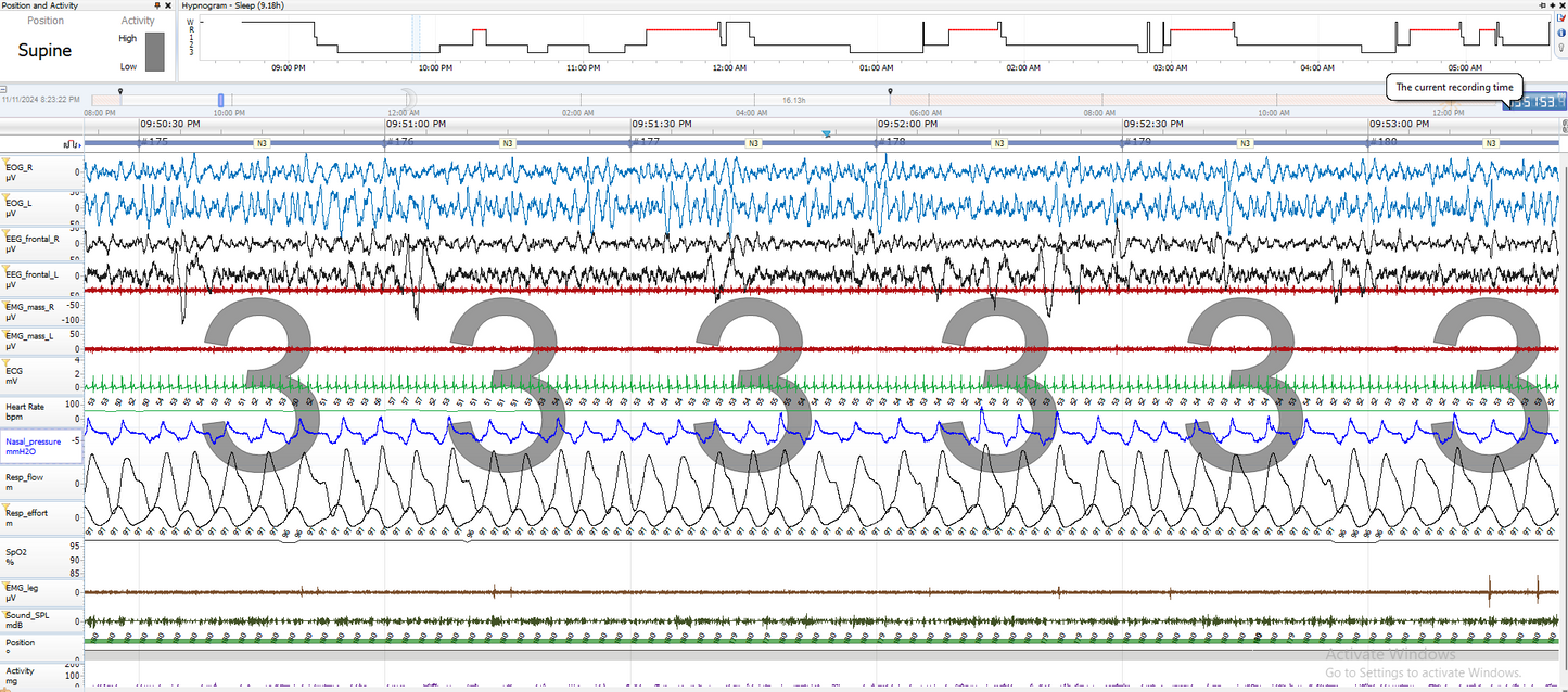 Two-Night Home Sleep Study (Onera Polysomnogram)